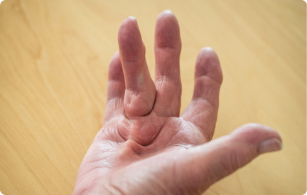 Close-up of a hand affected by early-stage Dupuytren’s contracture