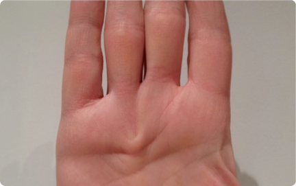 Close-up of a hand affected by thickening of the tissue in the palm